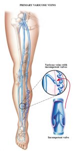 what are varicose veins