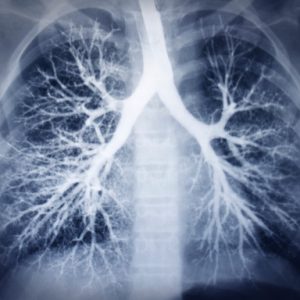 Pneumonia Vs Pneumonitis Differences In Symptoms Causes And Treatment