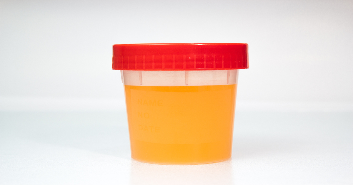 Proteinuria High Protein In Urine Causes Complication And Symptoms