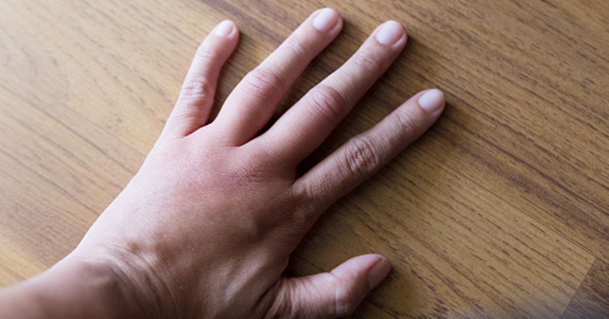 What Causes Swollen Knuckles And How To Reduce Swelling 