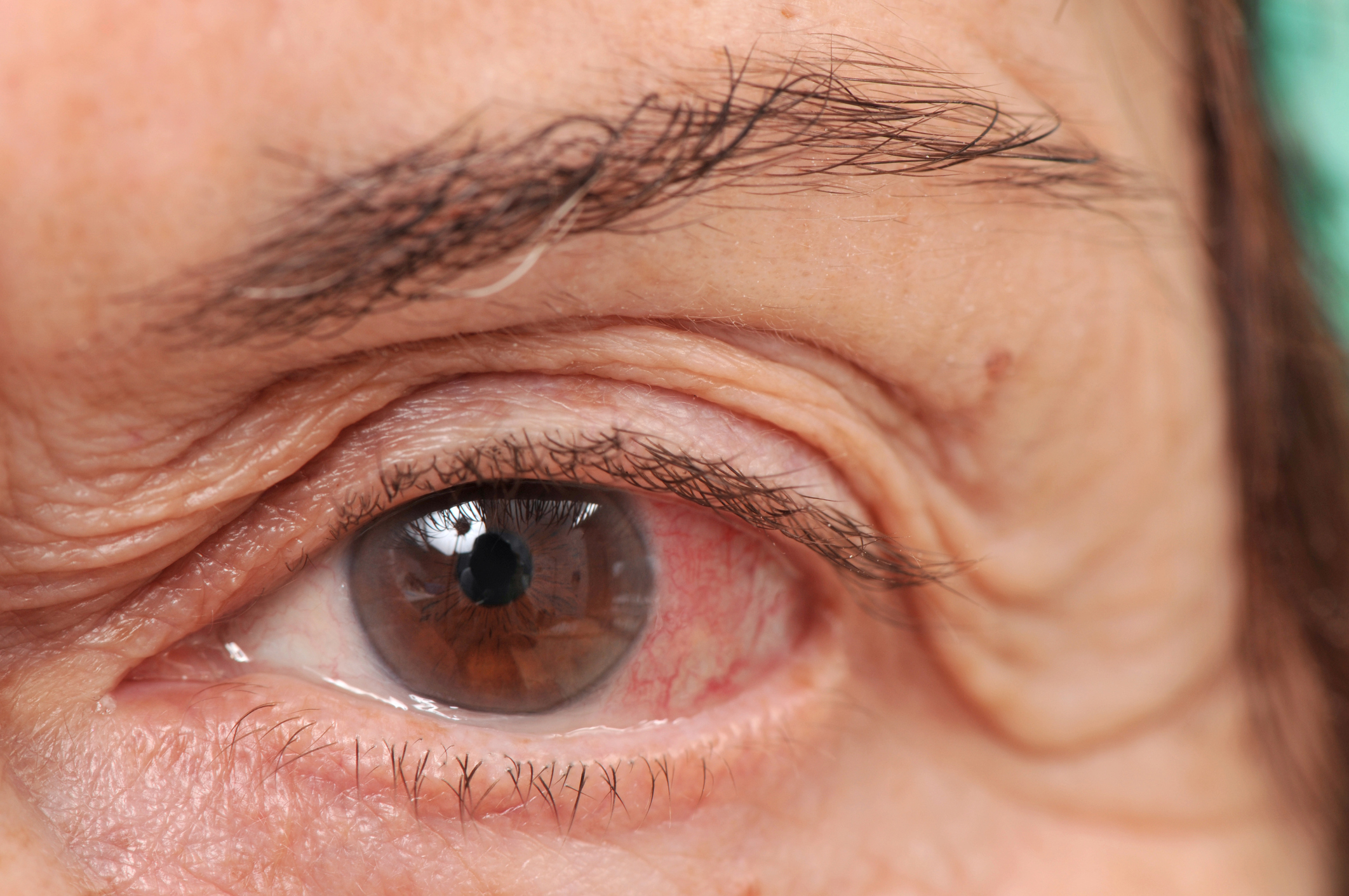 синдром сухого глаза симптомы фото