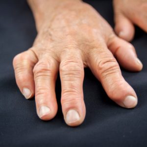 Psoriatic arthritis: Causes, symptoms and treatment