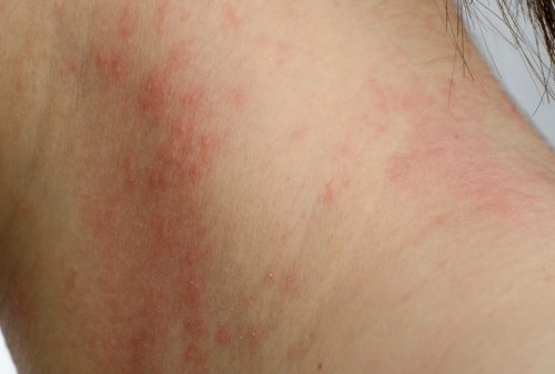 Contact Dermatitis Skin Rash From Allergens Triggered