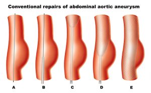 abdominal aortic aneurism risk may decrease with more than two fruit servings