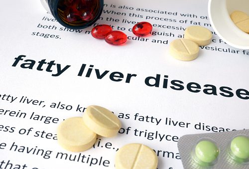 Fatty liver disease, NASH linked to a 50 percent higher mortality rate ...