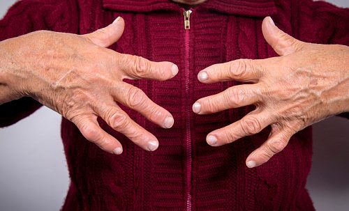 Rheumatoid arthritis raises risk of broken bones in young women