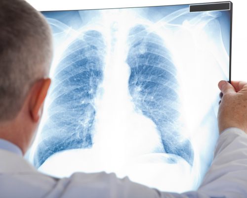 Rheumatoid arthritis affects lungs, raises risk of interstitial lung