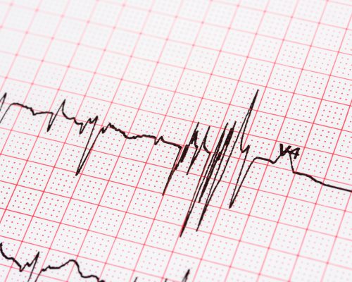 irregular heartbeat causes in adults