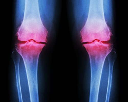 Osteoarthritis severity same as rheumatoid arthritis: Study