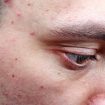 Stye Vs. Chalazion: Causes, Symptoms, Risk Factors, And Treatment