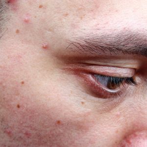 Stye vs. chalazion: Causes, symptoms, risk factors, and treatment