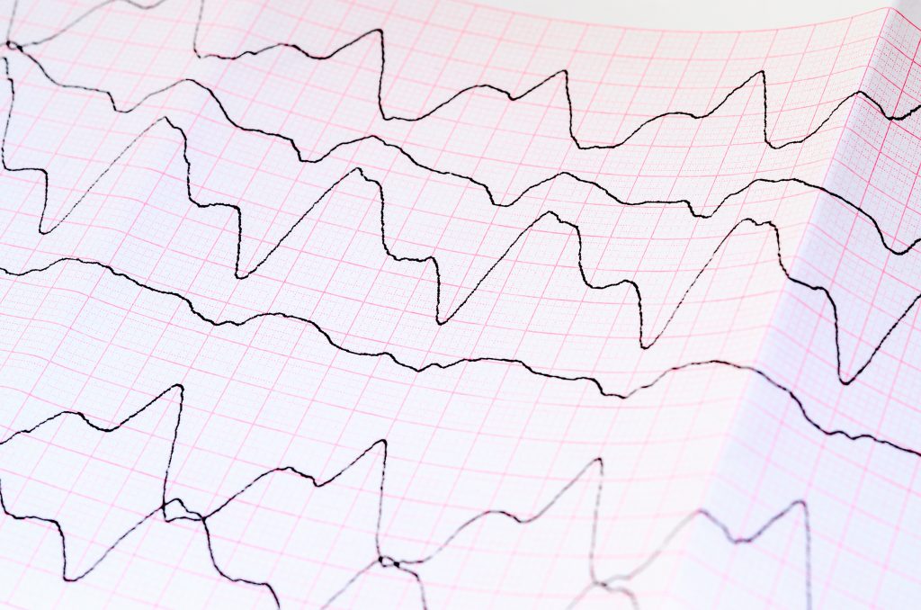 breathlessness-palpitations-and-tiredness-100-000-patients-with