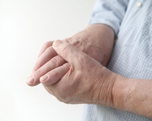 Rheumatoid arthritis patients face higher gout risk today than in the ...