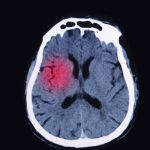 traumatic-brain-injury-tbi-risk