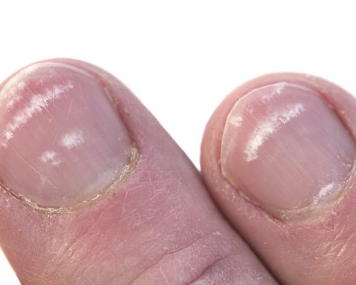 What Causes White Spots On Nails Leukonychia 