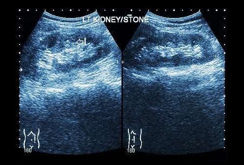 Noninvasive Kidney Stone Ultrasound Treatment Developed By Nasa Funded Research Team