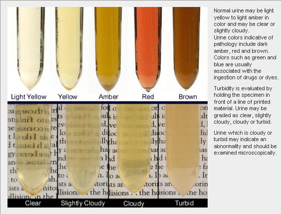 Leukemia Symptoms Urine Urine Cloudy Symptoms Pee Marra Urinary Tract 