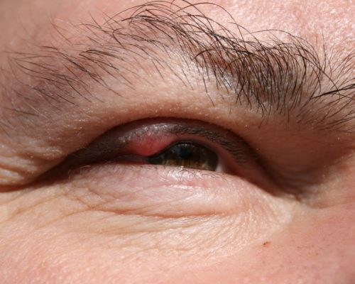 eyelid inflammation