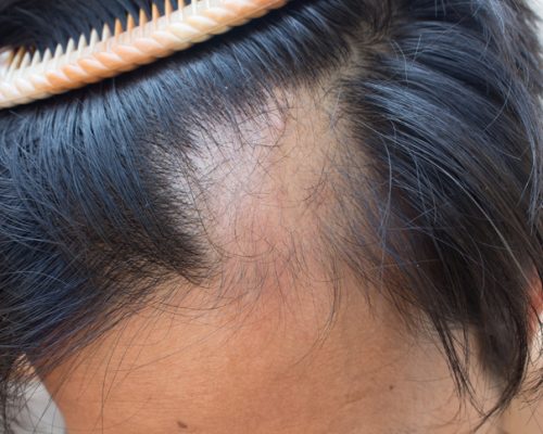 Certain Types Of Hair Loss May Be Treated With Arthritis Drug