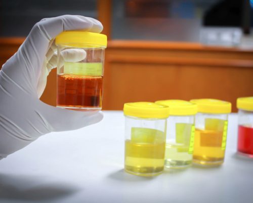 What The Color Of Your Urine Means