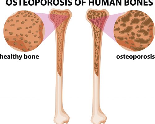 Simple Strategies to Manage Diabetes Related Bone Problems