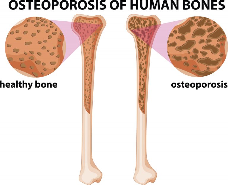 Simple Strategies To Manage Diabetes Related Bone Problems