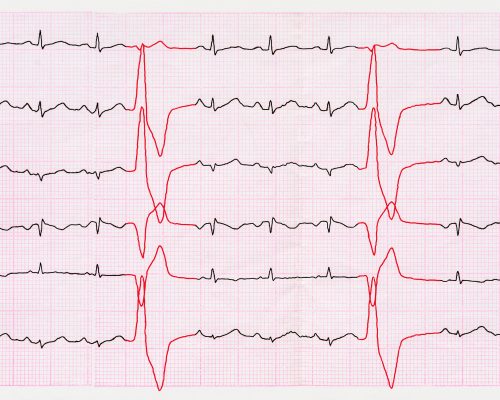 Heart Arrhythmia: Diagnosis, Tests, And Treatment Options