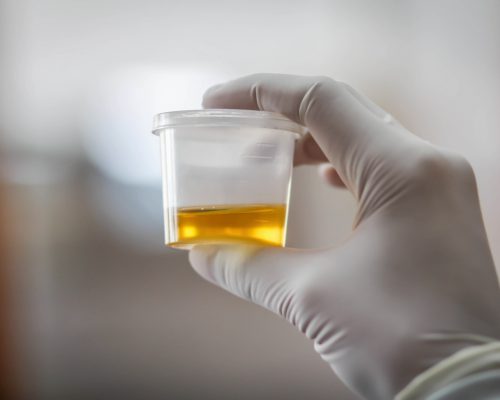 Leukocytes in urine: Causes, symptoms, and treatment