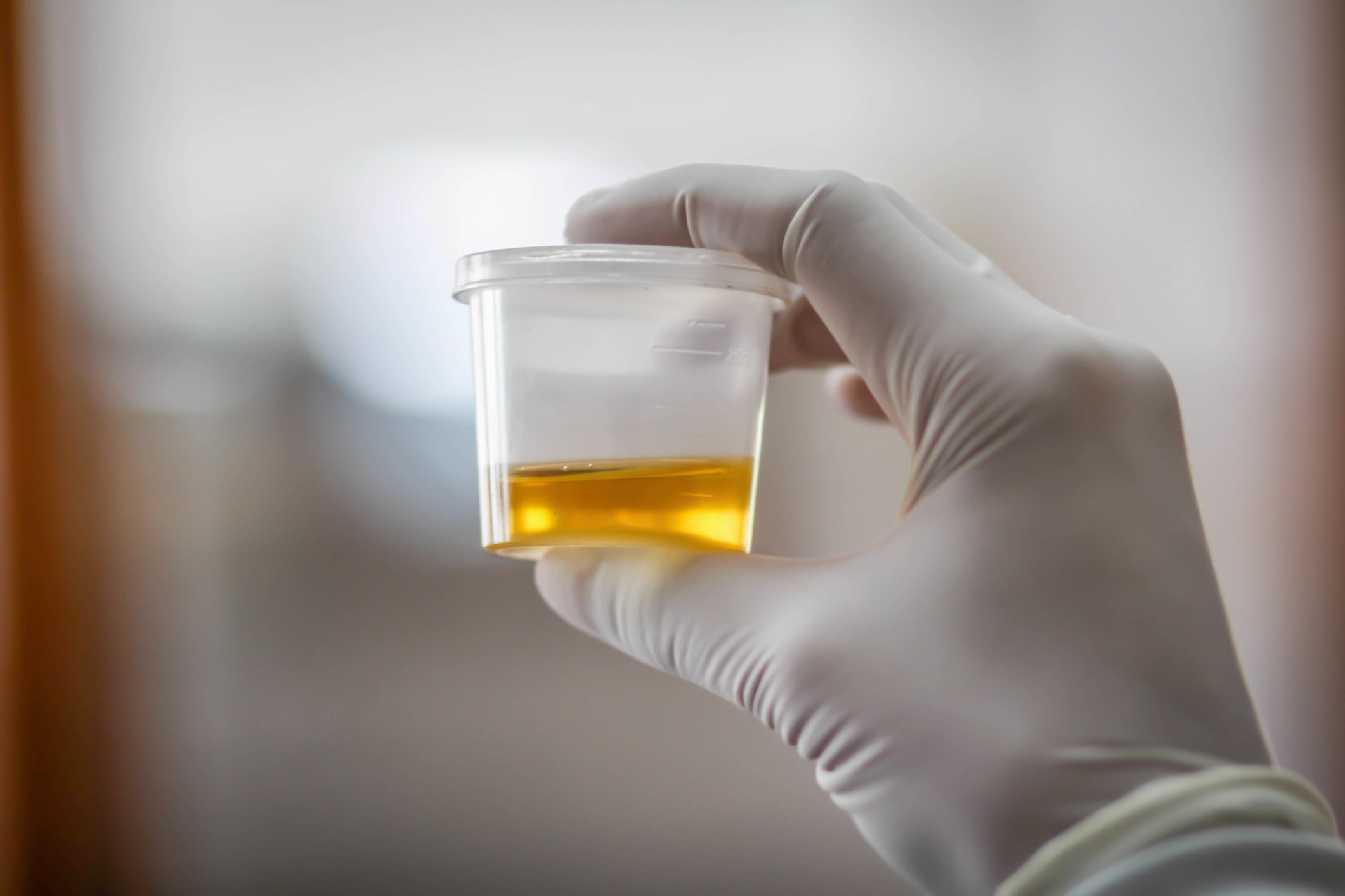 Leukocytes in Urine While Pregnant: Causes & Treatment