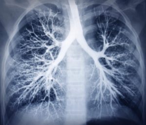 lupus-affects-lungs