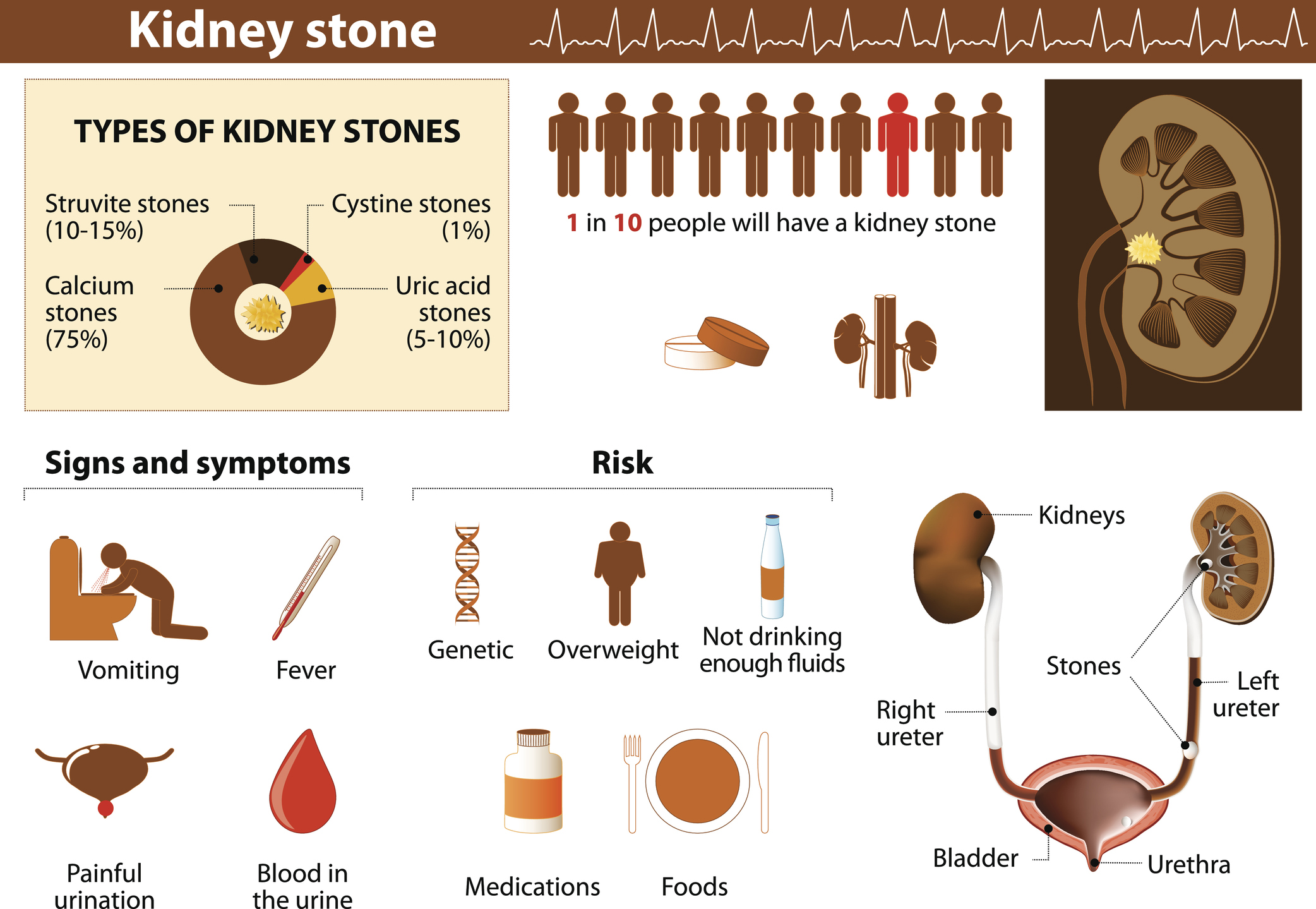 how to pass a kidney stone