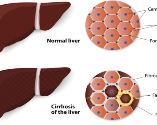 liver-fibrosis-or-scarring-leading-cause-of-liver-cirrhosis-can-be