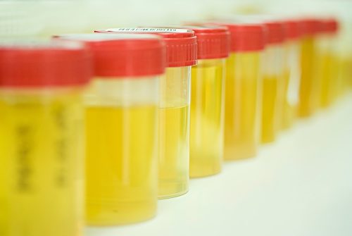 What Causes Oily Urine And Their Risk Factors