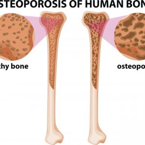 Osteopenia (bone loss) update: natural treatment, anti-inflammatory ...