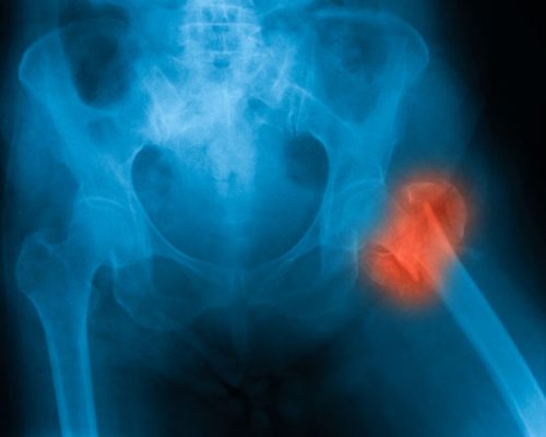 risk-of-death-linked-to-hip-fracture-may-last-for-years-after-accident