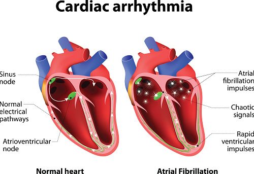 breakthrough-treatment-for-a-common-heart-problem