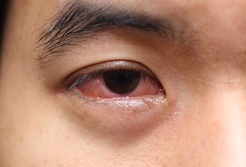 What Causes Mucus In Eye Eye Discharge And How To Get Rid Of It 