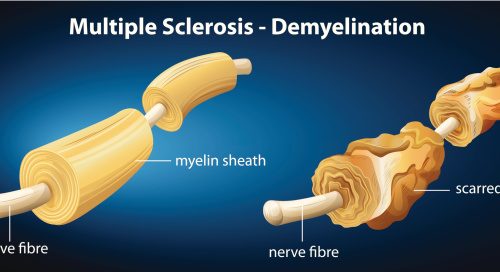 Multiple sclerosis is more complex than once thought: Study