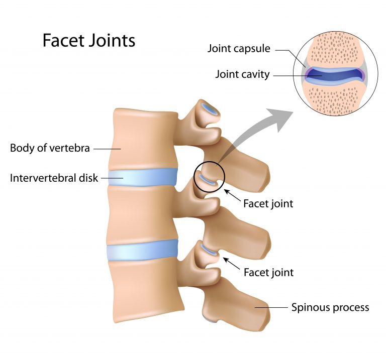 What Causes Facet Arthropathy Symptoms Diagnosis And Treatments 8439