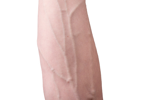 Blown vein: Causes, symptoms, tr...