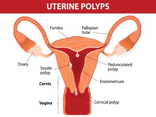 Uterine Polyps Endometrial Polyps Causes Symptoms And Treatment