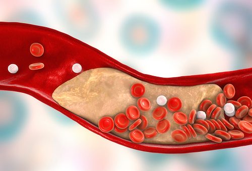 Acute Coronary Syndrome: Types, Causes, Symptoms, and Treatment