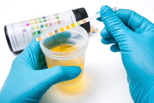 What Are The Various Causes Of White Particles In Urine 