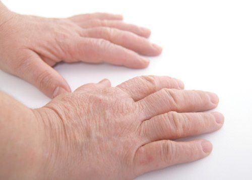 common-causes-of-swollen-hands