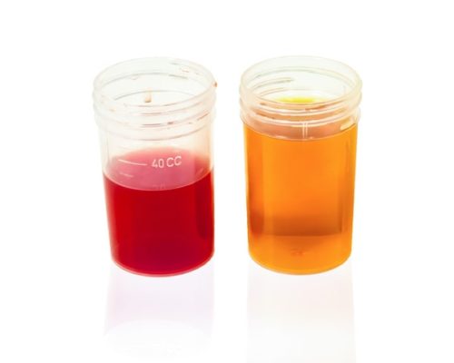 Why It s So Important To Look At Your Urine