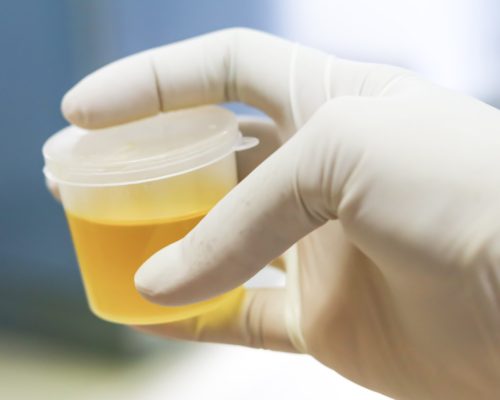 New urine test may help diagnose prostate cancer