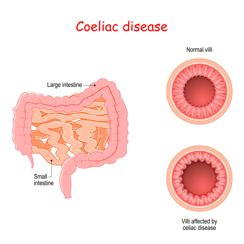 celiac-disease-symptoms-how-it-s-treated