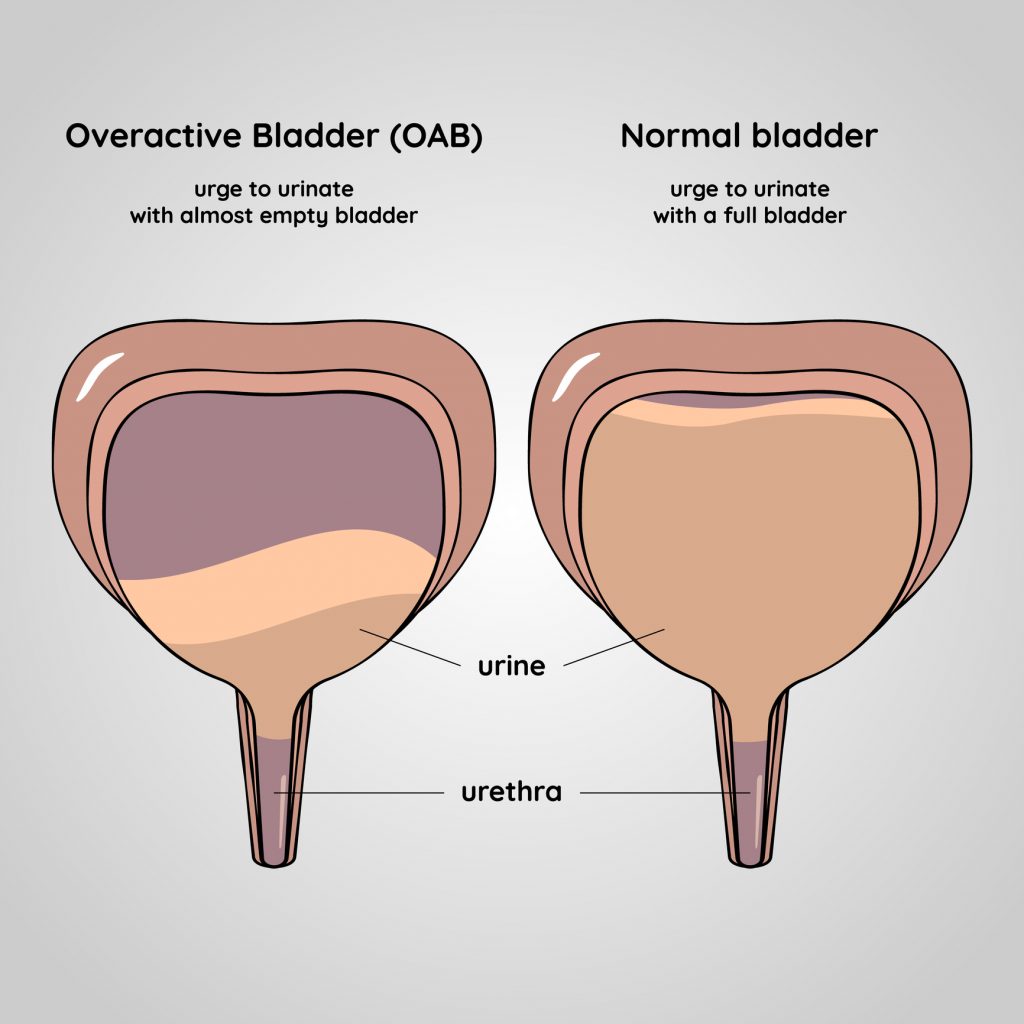 study-links-overactive-bladder-to-increased-falling-risk-in-older-adults