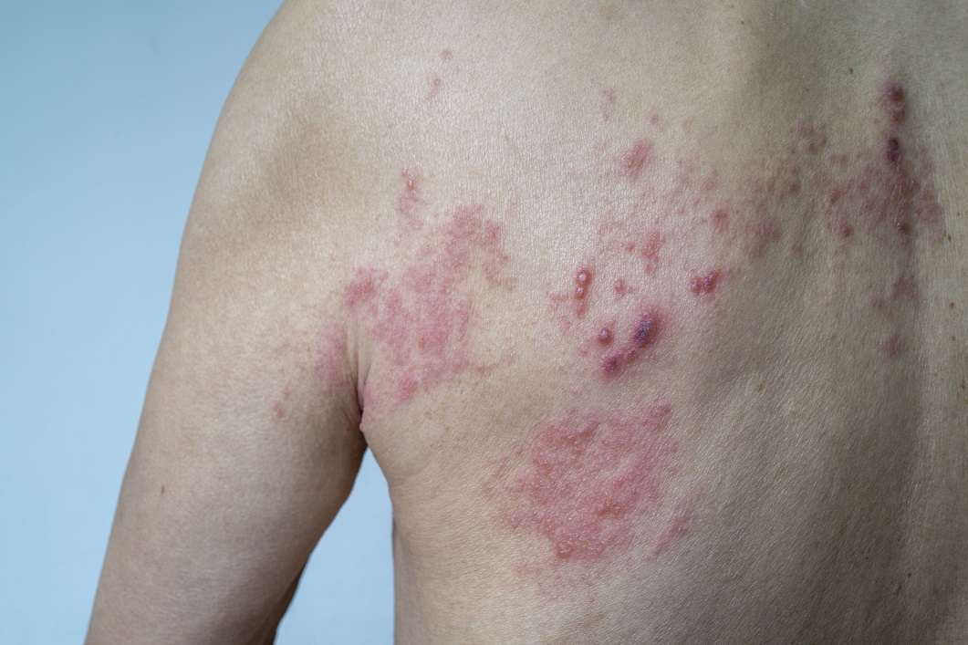 Shingles May Boost the Risk of Stroke, Heart Attack