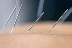 Acupuncture has shown positive effects on Sleep in Parkinson's Disease Patients